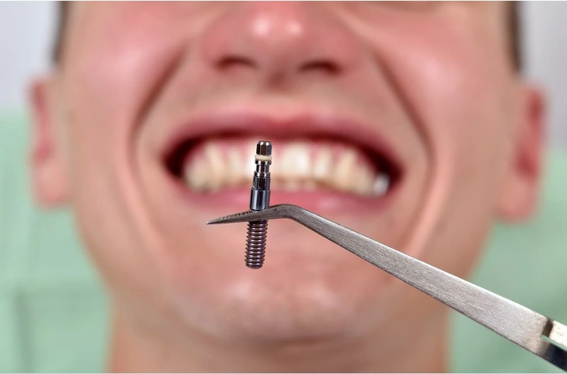 ایمپلنت دندان به عنوان یک جایگزینی دائمی برای دندان طبیعی استفاده می‌شود