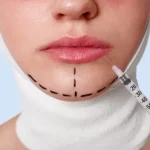 لیفت سانترال لب، یک روش جراحی است که با استفاده از آن می‌توان به مزایایی مانند افزایش تناسب لب با چهره و کاهش علائم پیری دست یافت.
