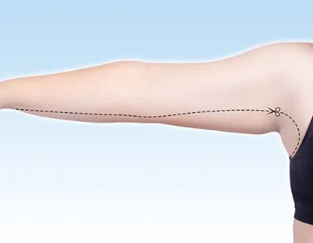 جراحی براکیوپلاستی باعث بهبود شکل و ظاهر بازوها می‌شود و مزایای براکیوپلاستی بهبود استقامت و عملکرد بازوها را نیز شامل می‌شود