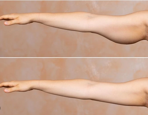 نکات مهم درباره جراحی لیفت بازو: بهبود شکل و ظاهر بازوها