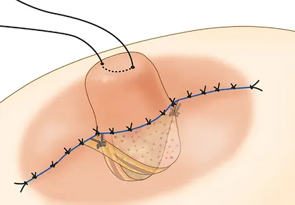در عمل نوک سینه، انواع روش‌های انجام جراحی نوک سینه شامل نازک‌سازی، جابجایی و تقویت نوک سینه می‌باشند.