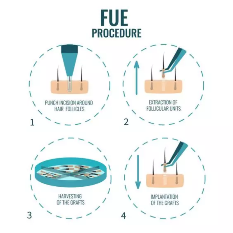 روش FUE، با دقت بالا و حداقل تداخل، راهی موثر برای بازیابی طبیعی و دائمی موهاست.