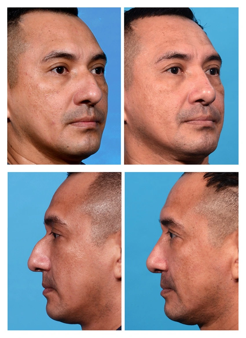 در جراحی بینی مردانه، اهمیت زیادی به انتخاب مناسب ارتفاع بینی داده می‌شود.