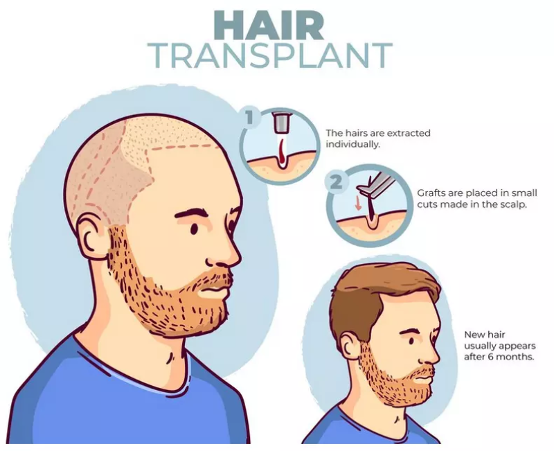 پیوند مو برای بازیابی موهای طبیعی