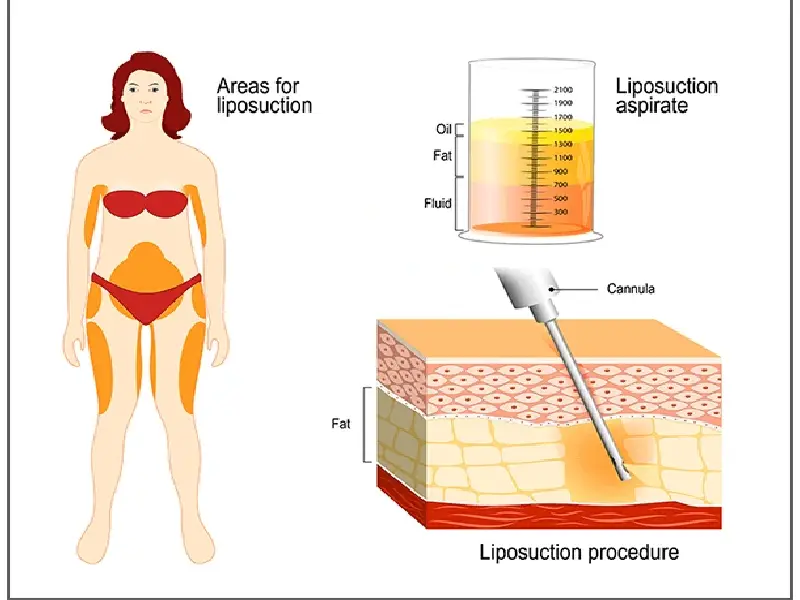 تفاوت لیپوست و لیپوماتیک، لیپوست اصطلاحی است که به پوست اشخاص اشاره دارد، در حالی که لیپوماتیک به یک روش جراحی کاهش چربی محلی از بدن اشاره دارد که با استفاده از فناوری های مدرن و دستگاه های خاص انجام می‌شود.