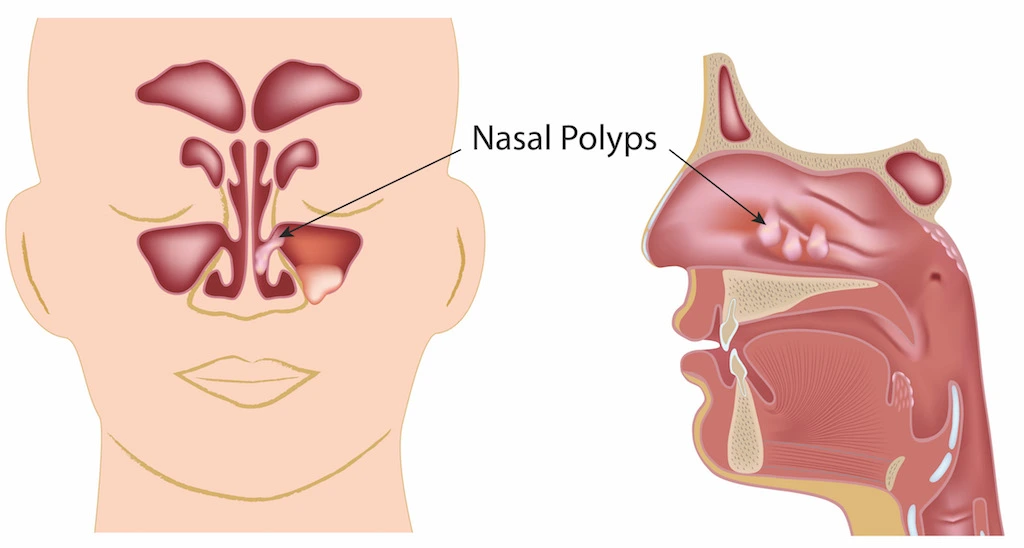 روش آندوسکوپی سینوسی یا روش بسته عمل پولیپ بینی یک فرآیند جراحی پیشرفته است.