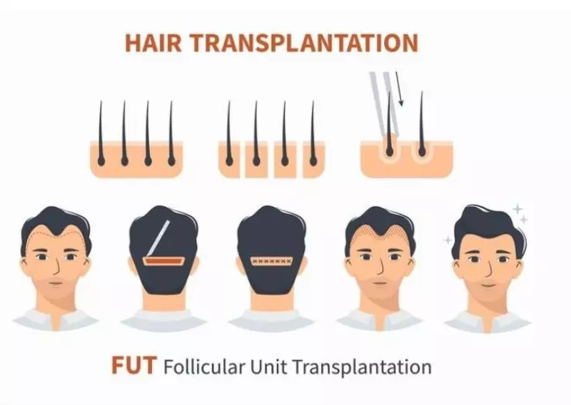 روش FUT تحولی بنیادین در بازسازی تراکم مو با نتایج طبیعی و دائمی.
