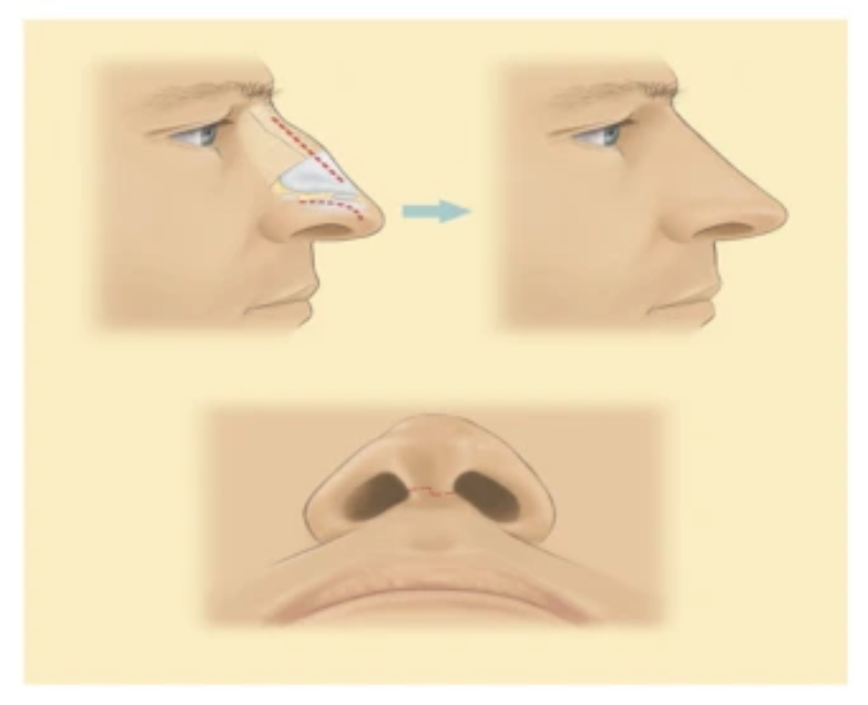 تامپون سیلیکونی بینی یک وسیله پزشکی است که برای حفظ شکل و پشتیبانی از بینی پس از جراحی پلاستیک بینی به کار می‌رود.