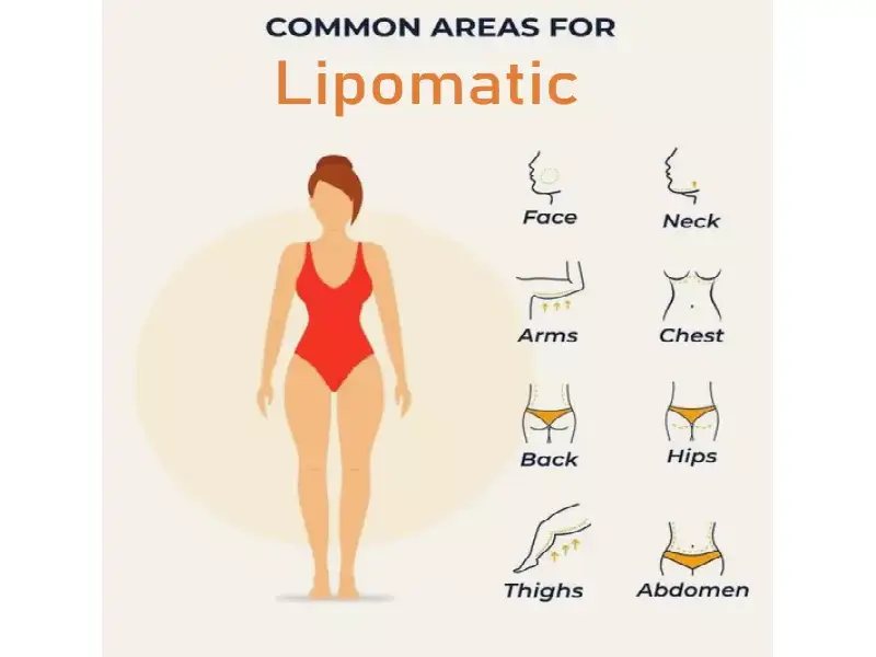 لیپوماتیک جراحی کاهش چربی در نواحی مختلف بدن مثل شکم، پهلوها، ران‌ها و صورت است.