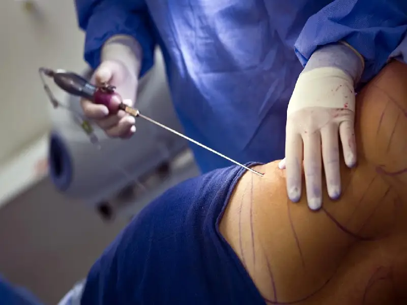 ساکشن سینه یک فرآیند جراحی زیبایی است که به منظور کاهش چربی زاید در منطقه سینه انجام می‌شود.