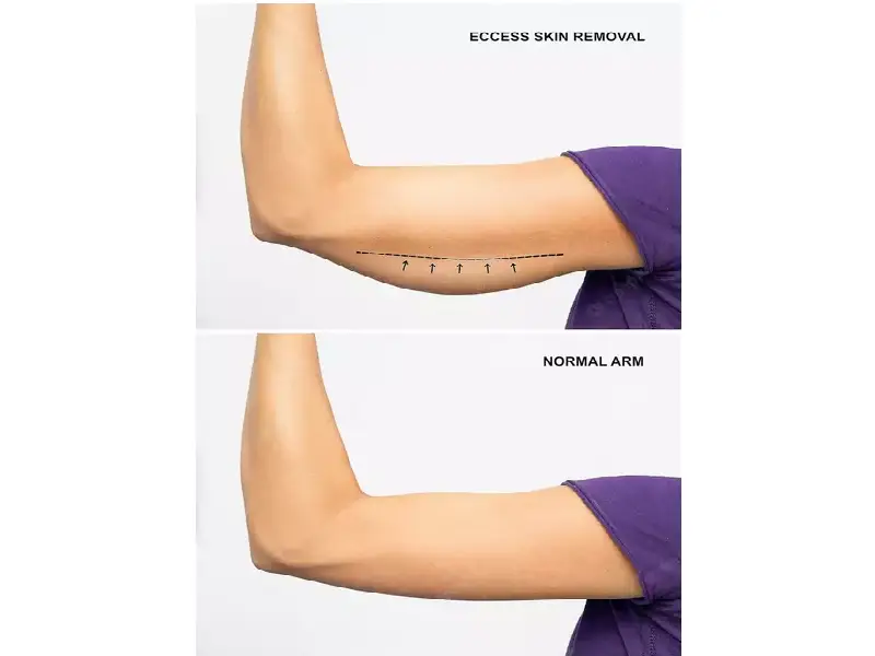 لیپوماتیک بازو برای زیبایی زنان امری بسیار مهم است.