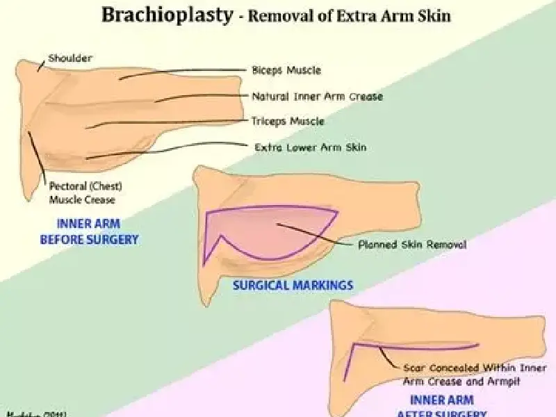 لیپوماتیک بازو به عنوان یک روش جراحی کم تهاجمی برای لاغری و تراشیدن ناحیه بازوها استفاده می‌شود. لیپوماتیک بازو به عنوان یک روش جراحی کم‌تراشم برای لاغری و تراشیدن ناحیه بازوها استفاده می‌شود.