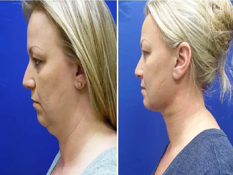 لیپو صورت گردن، یک روش نوین و موثر در جراحی زیبایی است.