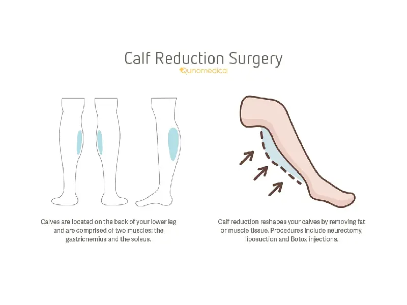 لیپوماتیک مچ پا با کمک قدرت یک روش نوین در جراحی زیبایی است.