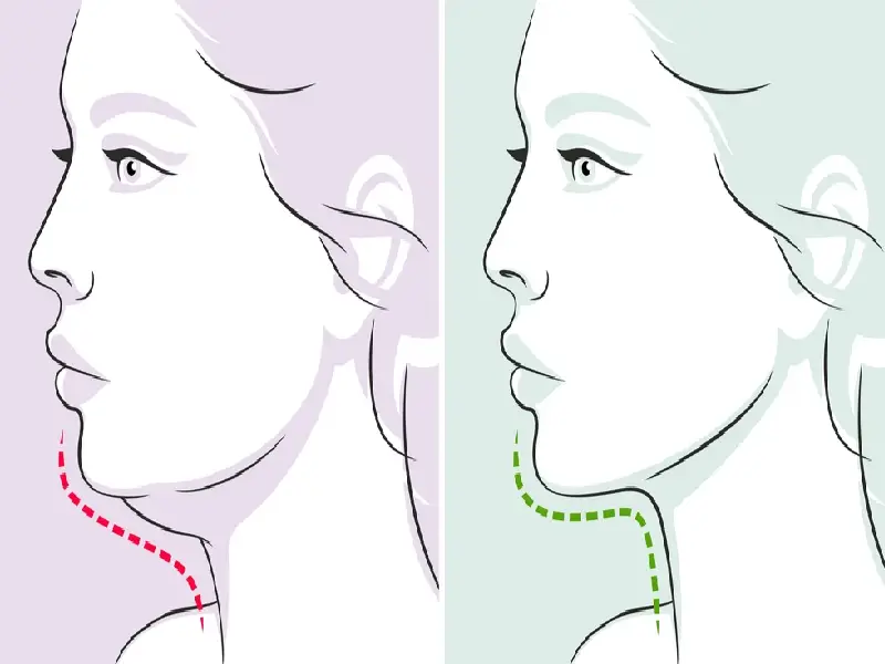 عمل لیپوماتیک صورت و گردن به دقت انجام شده و به همراه تغذیه مناسب و مراقبت پس از عمل، معمولاً باعث افتادگی پوست نمی‌شود.