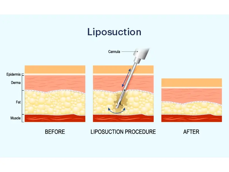 لیپوماتیک یکی از روش‌های جراحی زیبایی است که برای کاهش چربی‌های اضافی در بدن استفاده می‌شود.
