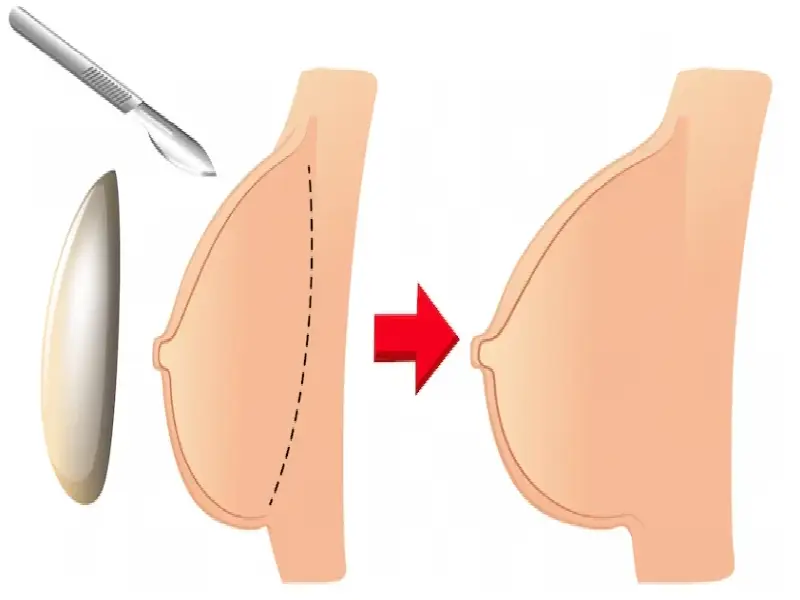پروتز سینه یک روش جراحی ترمیمی است که برای بازسازی یا افزایش حجم سینه‌ها استفاده می‌شود