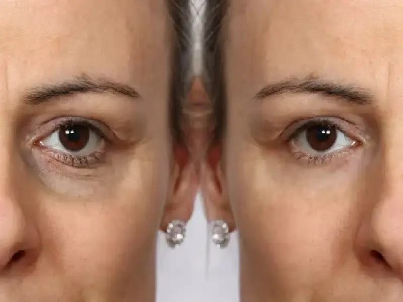 مزایای تزریق چربی زیر چشم به تازگی و جلوه جوانی پوست در این ناحیه کمک می‌کند.