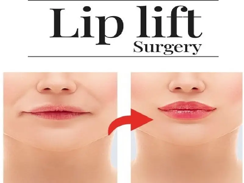 لیفت لب یک عمل جراحی است که به منظور کوتاه کردن فاصله بین بینی و لب بالا و افزایش قوس لب بالا انجام می‌شود.