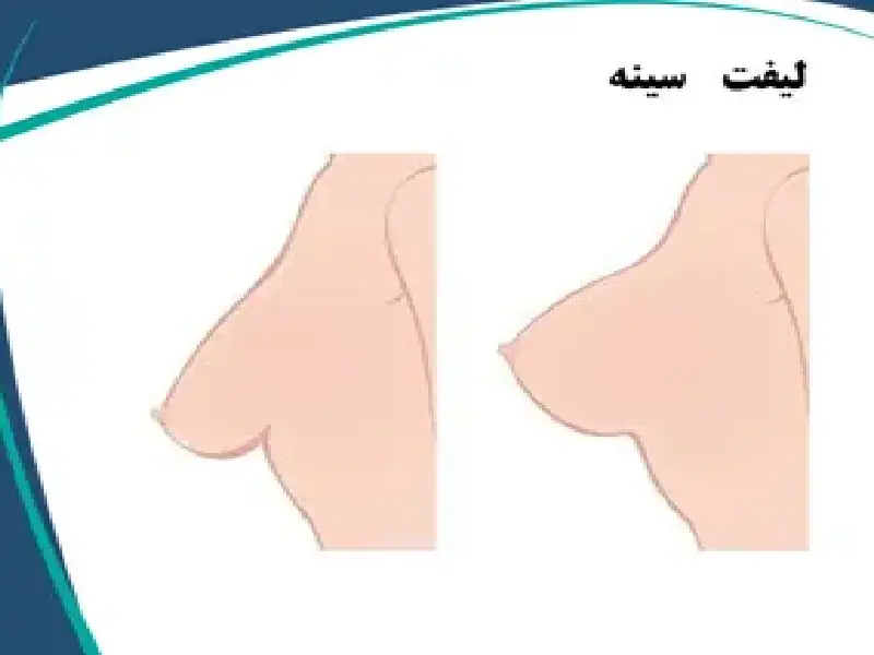 لیفت سینه یک فرایند جراحی است که مزایایی مانند اصلاح افتادگی سینه و بهبود تصویر بدنی را به ارمغان می‌آورد.