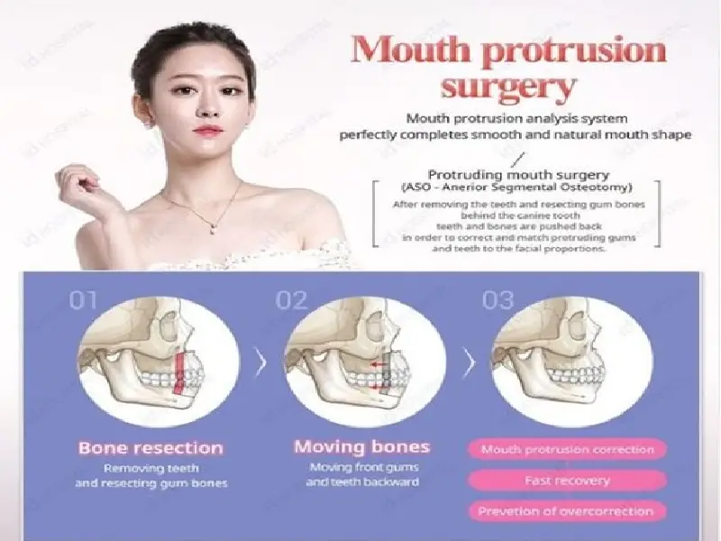 جراحی کوچک کردن دهان می‌تواند یک گزینه‌ی مناسب برای افرادی با مشکلات ظاهری در دهان خود باشد.