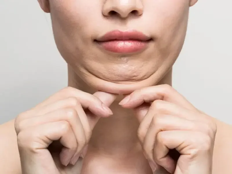 نتایج لیپوماتیک صورت گردن دائمی است زیرا چربی‌های حذف شده از مناطق مختلف به‌طور دائمی از بدن افراد حذف می‌شوند.