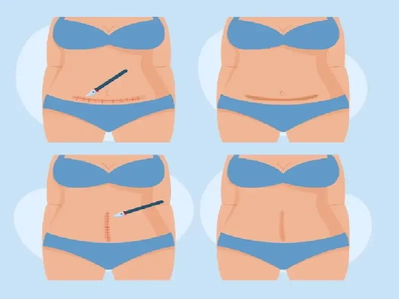 عمل پیکرتراشی یک روش موثر و پرکاربرد در جراحی زیبایی است که برای تغییر شکل بدن