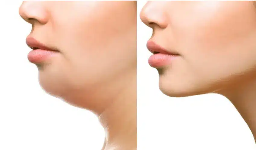 o fat removal, double chin lipomatic can also improve the skin's texture and tone in the treated area