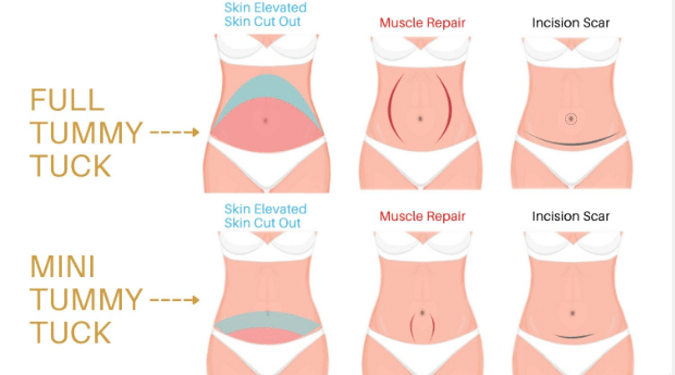 Abdominoplasty surgery goes beyond fat removal and addresses loose skin and weakened abdominal muscles.