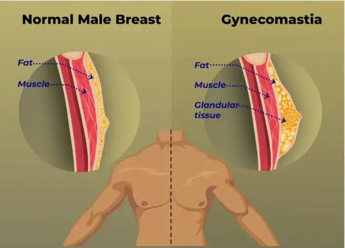 Gynecomastia is a condition characterized by the enlargement of breast tissue in males.