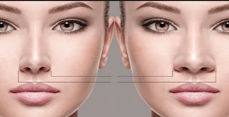 Many individuals with a fleshy nose opt for a nose job to enhance their appearance and achieve a more balanced facial profile