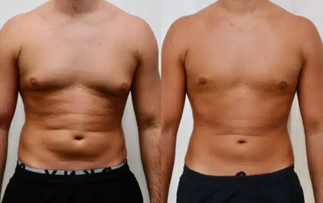 To ensure optimal healing and minimize complications, patients should follow these do's and don'ts after Gynecomastia Surgery.