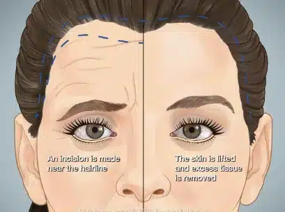 By correcting brow asymmetry, the surgery can restore balance and harmony to the overall facial appearance. 
