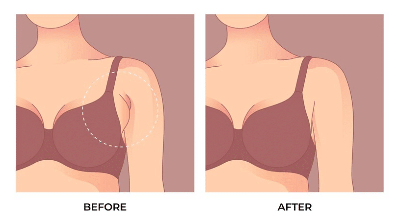The benefits of breast augmentation include increased breast volume, improved breast symmetry, and enhanced body proportion.