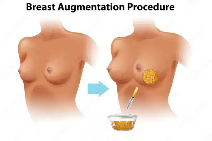 fat transfer breast augmentation and breast implants offer distinct approaches to breast augmentation.