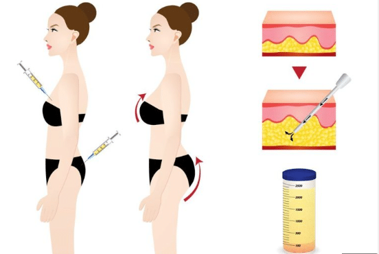 Different types of fat transfer, such as fat grafting surgery and facial fat transfer, offer individuals various options to enhance their appearance and achieve their desired aesthetic goals