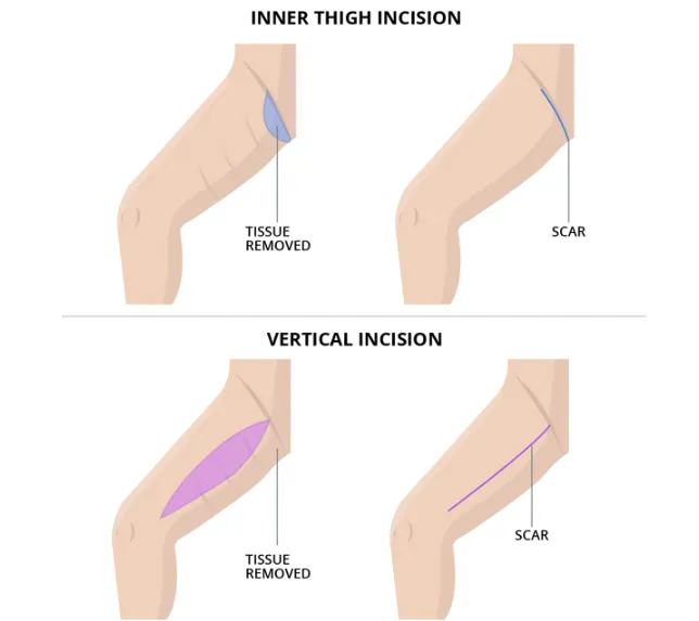 A thigh lift, or thighplasty, is a surgical procedure designed to reshape and contour the thighs,