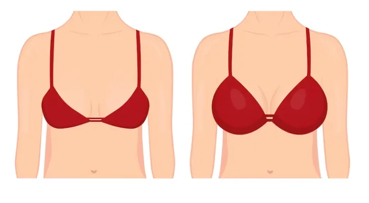 Prosthesis Paxi, or breast lift surgery, offers transformative benefits