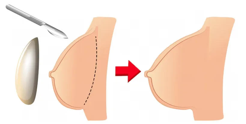 The benefits of mammoplasty extend beyond cosmetic enhancements, as breast surgery can also help restore breast symmetry and improve body proportion