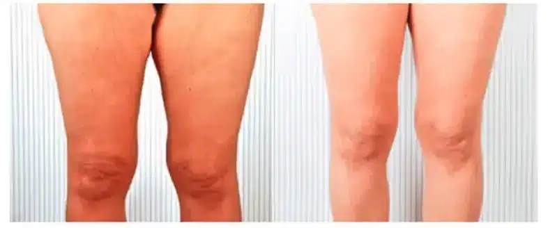 Sculpt your leg contours with leg lipomatic procedure.