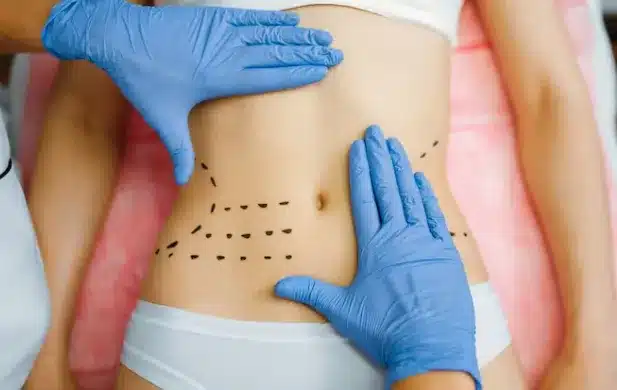 Liposuction surgery is a medical procedure that targets and removes excess fat cells from specific areas of the body.