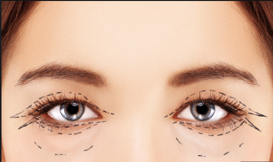 The patient opted for a combination of upper and lower eyelid surgery during their blepharoplasty