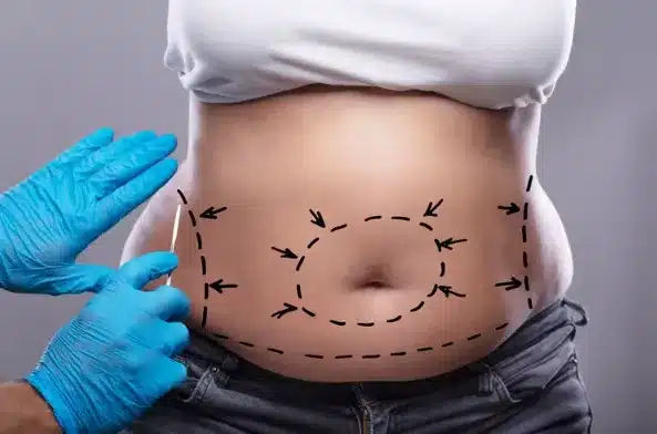 Abdominoplasty aftercare offers numerous benefits, including minimized complications,