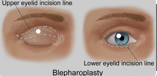The patient underwent an upper eyelid surgery, specifically a blepharoplasty, to improve their vision.