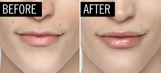The benefits of lip reduction, achieved through the surgical procedure, include improved facial proportions,