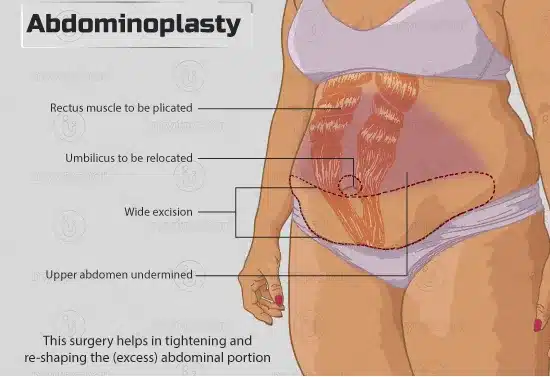 Proper abdominoplasty aftercare is essential for optimal results and a smooth recovery following a tummy tuck.