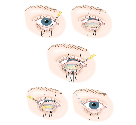 Before undergoing lower eyelid surgery or lower blepharoplasty, it is essential to consult with a qualified surgeon to discuss your goals and expectations.
