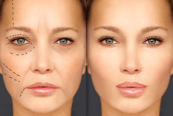 Facial fat transfer surgery is a versatile procedure that can address multiple concerns, such as hollowed cheeks or deep lines and wrinkles.