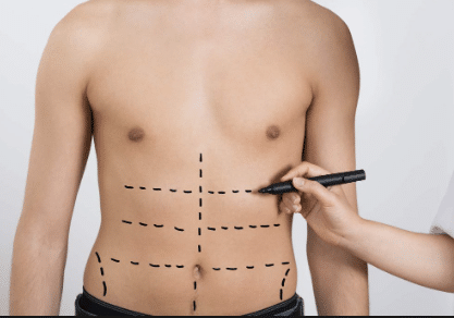 Individuals seeking body contouring can choose from different types of lipomatic in Iran