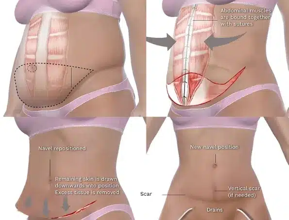 Abdominoplasty after pregnancy, also referred to as a tummy tuck after pregnancy, offers the benefits of removing excess skin and fat